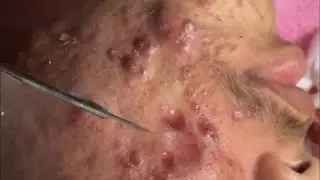 Удаление черных точек 2021 - Remoção de cravo 2021 - Pimple Popping 2021 -Blackhead Removal 2021