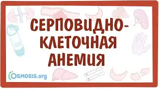 Серповидно-клеточная анемия  — причины, симптомы, патогенез, диагностика, лечение