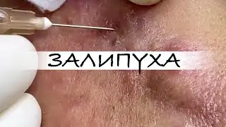 ПРЫЩИ 😍 ПРЫЩИ ВЫДАВЛИВАНИЕ 😍 ПОДБОРКА ВЫДАВЛИВАНИЕ ПРЫЩЕЙ 