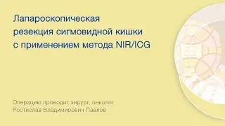 Лапароскопическая резекция сигмовидной кишки с применением метода NIR/ICG