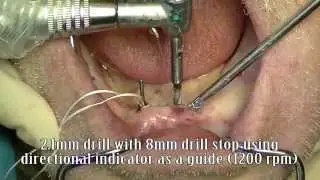 Zest LODI Basic Mandibular Overdenture Surgery and Prosthetics