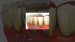 Periodontitis and Laser Hardening Surgery: 3D Animation