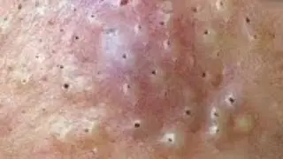 Blackheads & Whiteheads Satisfying Removal @0271