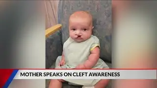 Kokomo mom speaks on Cleft awareness