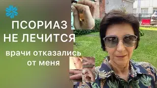 Псориаз не лечится. Врачи отказались от меня