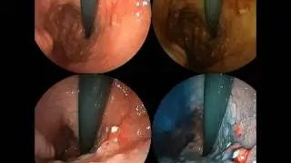 mesothelioma cancer center