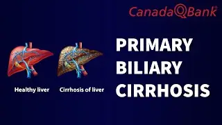 Primary Biliary Cirrhosis