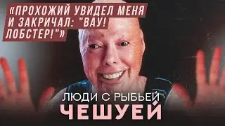 Люди с рыбьей чешуей: ихтиоз | Хочу спросить