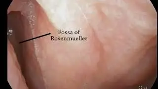 Fiberoptic nasopharyngoscopy