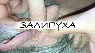 ПРЫЩИ ВЫДАВЛИВАНИЕ  😍 ПОДБОРКА ВЫДАВЛИВАНИЕ ПРЫЩЕЙ #прыщи #acne #asmr