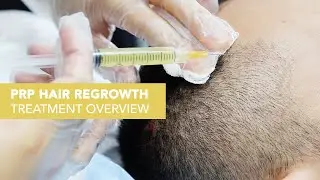 PRP + ACell for Hair Loss in San Francisco | Usha Rajagopal