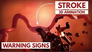 How to Recognize a Stroke? | 3D Animation