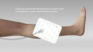 Avance Solo - L'application sur la plaie