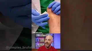 Foot Cyst Pop! 