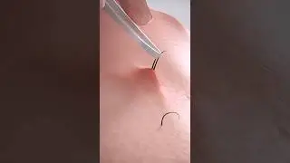 How Ingrown Hairs Are Removed