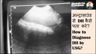 #DH in Buffalo/#USG of DH/#diaphragmatic hernia in buffalo/#drrbk