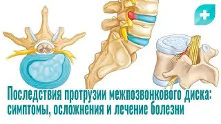 Последствия протрузии межпозвонкового диска: симптомы, осложнения и лечение болезни