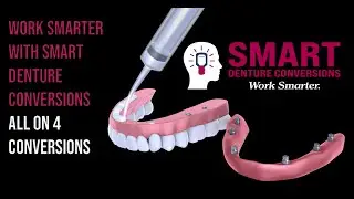 WORK SMARTER with Smart Denture Conversions - #allon4 #allonx Denture Conversion System