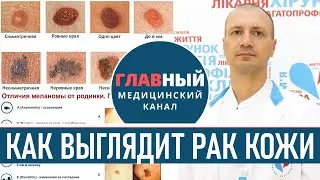 Как выглядит РАК КОЖИ (фото 1-8). Меланома, базалиома и плоскоклеточный рак кожи