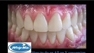 [Webinar] How to Do All-on-4 Full Mouth Conversions with Mark Williamson CDT, DTG