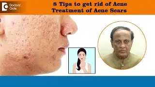 8 Tips to get rid of ACNE SCARS | Best Treatment for Deep Acne Pits - Dr.D A Satish| Doctors Circle