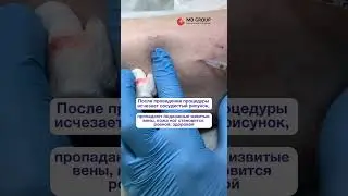 Лечение варикоза вен на ногах 