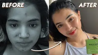 CLEAR SKIN IN 2 WEEKS (MY ACNE JOURNEY) | Cedie & Rosie
