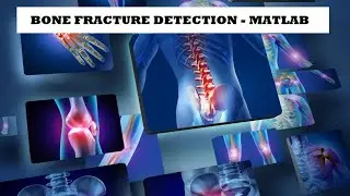 Bone Fracture Detection Using CNN | MATLAB | Image Processing #matlab #deeplearning