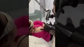 Удалили тату за 1 сеанс