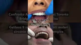 Confronto allon4/6 Toronto Bridge con 12 denti con gengiva Galileus 14 denti  zirconio senza gengiva