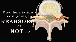 Disc herniation - is it going to reabsorb...or not..by Mr. Janis Slezins