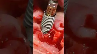 Implant Insertion 🍿🍿 