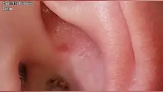 Top 10 Ear Pops!  Ear Blackheads, Pimples, Zits and Acne Popping!