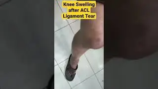 Knee Swelling ACL Ligament Tear | Knee Effusion| 