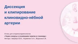 Диссекция и клипирование клиновидно-нёбной артерии. Процедуру проводит Аркадий Николаевич Науменко.