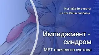 Импиджмент синдром