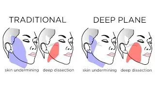 The Deep Plane Facelift is SO HOT right now. Why? | Marc Jacobs | FAQ