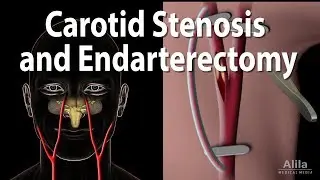 Carotid Stenosis and Carotid Endarterectomy, Animation