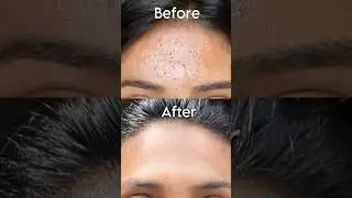 How to Get Rid of Tiny Bump in 30 Days✨ 