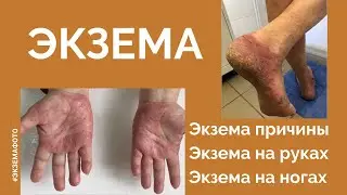 Экзема. Экзема причины. Экзема на руках. Экзема на ногах. Экзема фото.