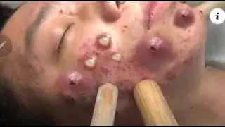 Удаление черных точек 2021 - Remoção de cravo 2021 - Pimple Popping 2021 -Blackhead Removal  EP004