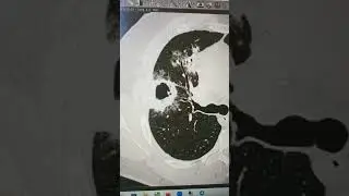 Кавернозный туберкулёз на КТ