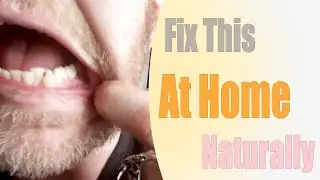 How I fixed my receeding gums at home naturally