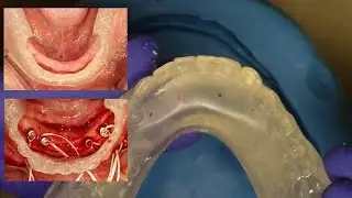 Easy Clinical & Laboratory Technique for Fabricating an "In-House Surgical Guide" for Overdentures