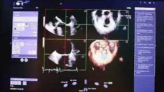 Mitral Valve Analysis: Siemens eSie Valve