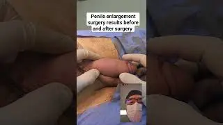 Penile enlargement surgery results before and after surgery 