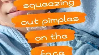 squeezing out pimples on the face/Выдавливание прыщей, гнойников, черных точек. #23