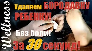 Как 100% избавиться от бородавки! Быстро! Без боли!