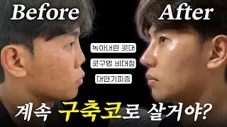 코수술만 4번째... 이제는 그만..!! 🤯| 최종_진짜최종_찐최종 구축코 재수술 후기