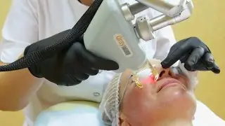 Омоложение лица ЛАЗЕРОМ. Как это?  До и После.